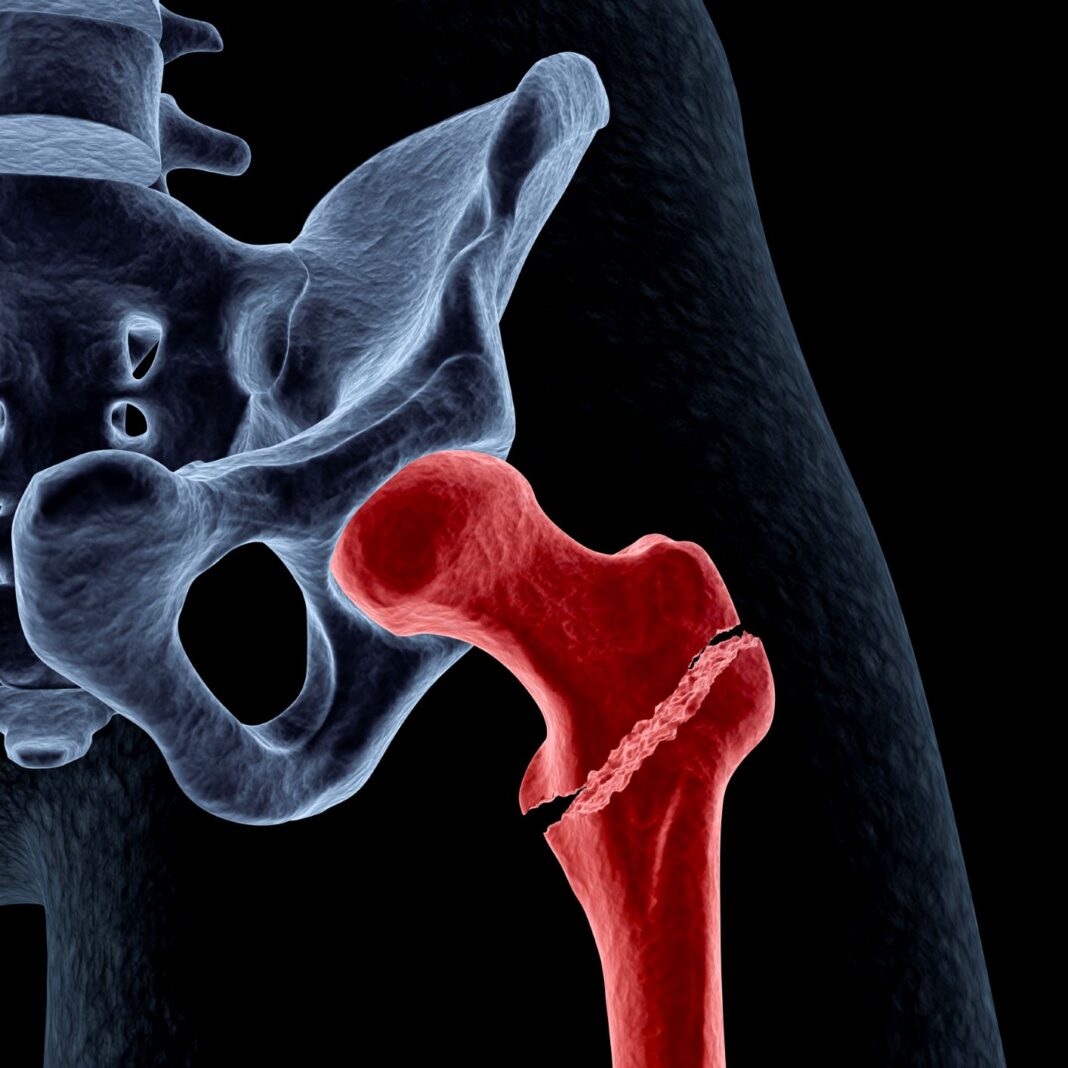 X-ray graphic of hip fracture