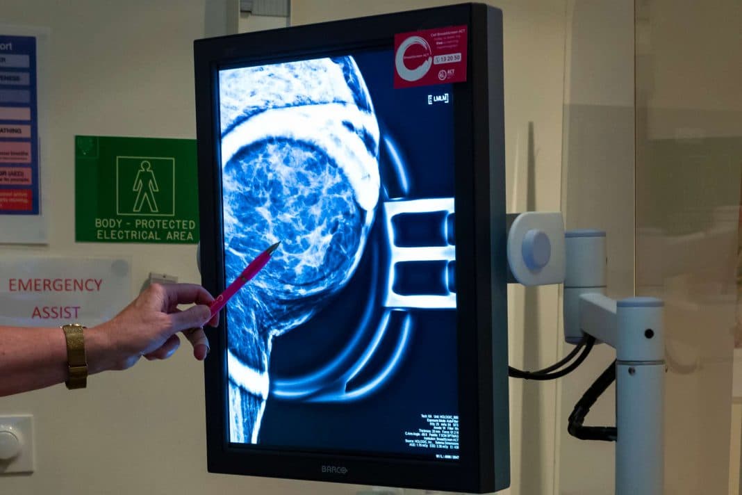 screening of a breast with cancer detected in the scan highlighting the benefit of getting screened because the machine can detect tiny specks of cancer