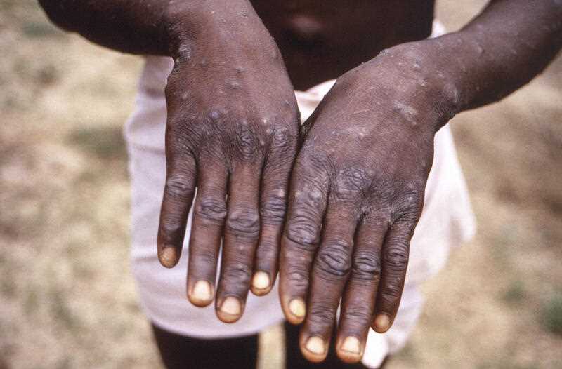 the hands of a monkeypox case patient, who was displaying the appearance of the characteristic rash during its recuperative stage