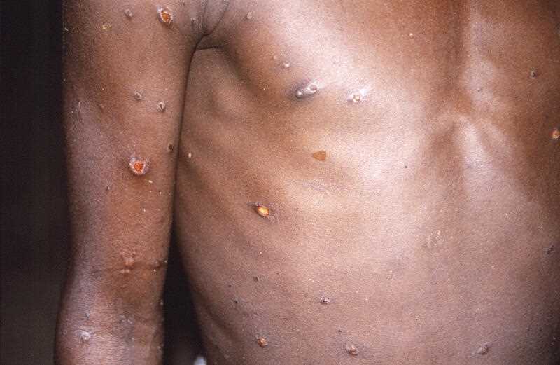 This 1997 image provided by U.S. Centers for Disease Control and Prevention shows the right arm and torso of a patient, whose skin displayed a number of lesions due to what had been an active case of monkeypox